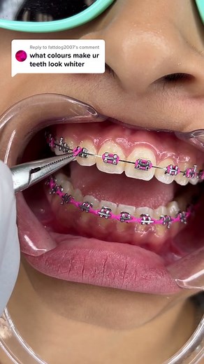 Replying to @fattdog2007 Best Braces Colors for Whiter Looking Teeth ✨ #bracescolors #learnontiktok