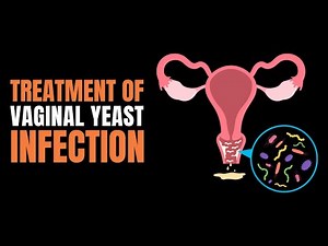 What To Do For Vaginal Yeast Infection? | Find Out The Treatment of Vaginal Yeast Infection