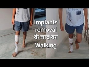 tibia fibula fracture recovery | After Implants removal