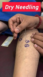 14K views · 66 reactions | Needle Magic: Transforming Lives with Dry Needling in Kolkata #dryneedling #painawaysolution #physiotherapy #fbreelsfypシ゚ #painreliefcenter #doctor #bestpainreliefclinic #chiropractic #ChiropracticCracks #cracks #Reliefs #bestchiropractor #bestchiropractorinkolkata #treatment #yogaflow #kolkata #durgapur #asansol #malda #siliguri #fb #fbshortvideo | PAIN Away Solution | Facebook