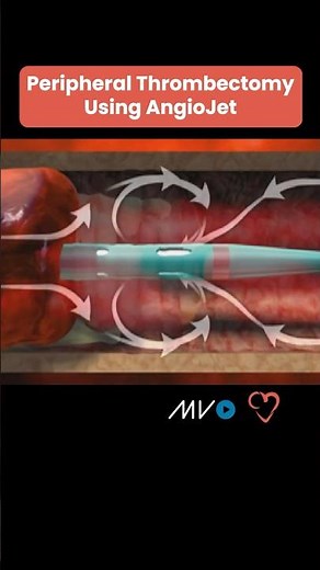 AngioJet Peripheral Thrombectomy System ✨🩸 #cardiologyeducation #cardiology