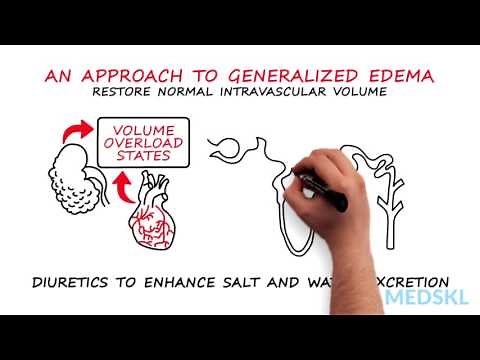 Nephrology – Generalized Edema: By Timothy Yau M.D. and Michael Connor M.D.