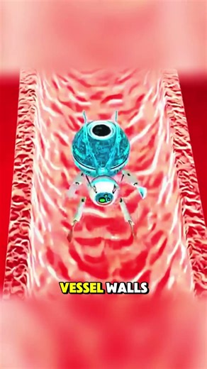 How Nano Robot Atherectomy Procedure (3D Animation) #cardiology#medical3d #3danimation