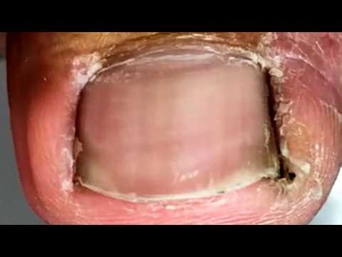 The Toenails Are Dirty Clean The Ingrown Toenail~【Crazy pedicure room】