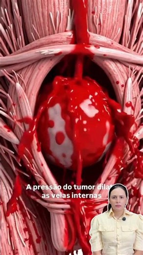 Mioma Uterino: Sintomas, Sangramento Intenso e Tratamentos