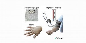 Pregnancy- Induced Hypertension (PIH; preeclampsia and eclampsia) Nursing Care Plan & Management - RNpedia