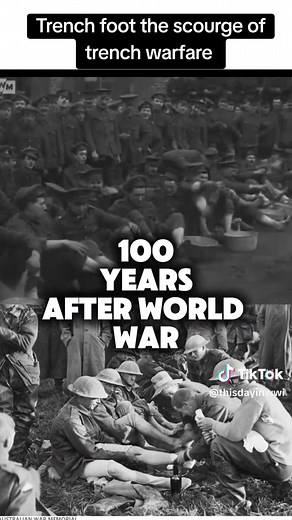 Trench foot is a condition, common in #WW1, when wet feet cause damage to the feet's skin. Unlike frostbite, trench foot usually happens during cold but above freezing temperatures. In the water logged British trench there were up to 75,000 causalitise due to Trench Foot. In 2017 a study found that the pain of trench foot is from,