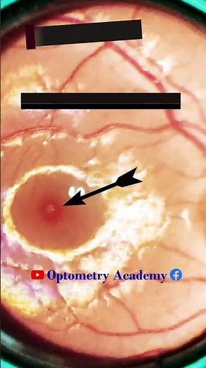 Normal fundus with foveal reflex present | Normal fundus | Normal Retina | Short Video 114