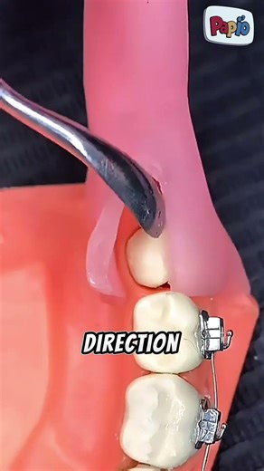 Hidden Tooth Growing Sideways? Here’s Why Dentists Must Remove It