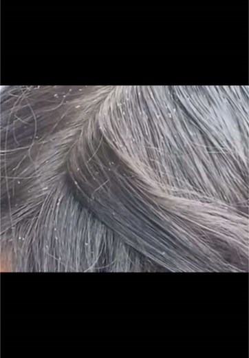 Lice picking #lice #kuto #asmrsounds #satisfying