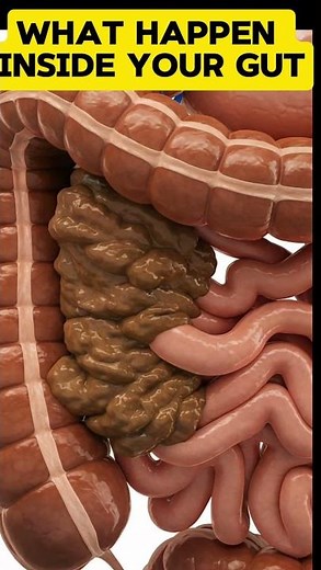 You Won’t Believe What Constipation Looks Like Inside