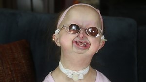 91M views · 2.3M reactions | Michelle is one of only a few hundred people ever known to have Hallerman-Streiff syndrome. Instead of worrying about the future, she just takes life one day at a time. | Special Books by Special Kids | Facebook