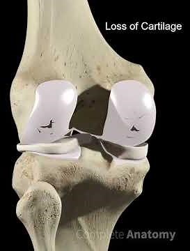 Tricompartmental Osteoarthritis