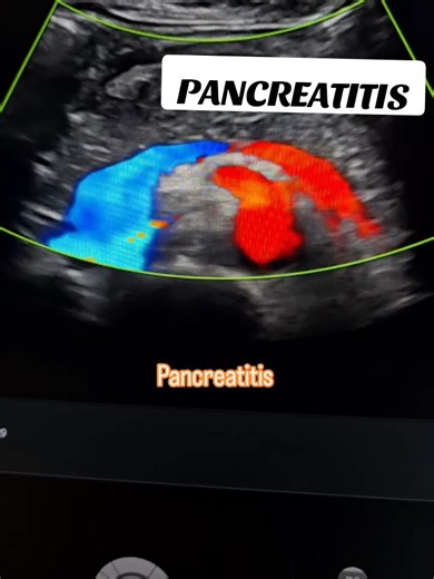 Ultrasound Findings in Pancreatitis