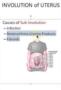 Obstetrics Causes of subinvolution Uterus Viva