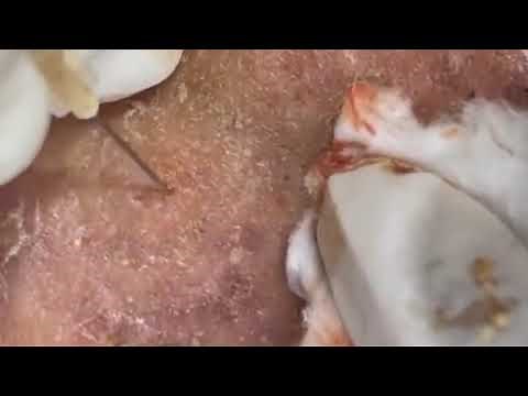 ​Acne Treatment(78)Enjoy Your Day with Win Spa #01