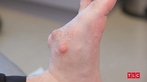A huge tumor in Tony's foot is wreaking havoc on his life! Can Dr. Ebonie safely cut it out? ✂️ #MyFeetAreKillingMe | TLC