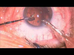 Alcon SN60WF 2.2 phaco Lukan Mishev Live Stream