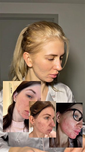 How I treated my cystic acne #cabincrewlife #cysticacne #acnetreatment #skincareroutine