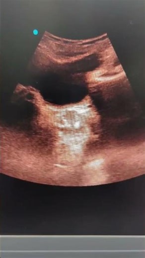 prostate calcification#ytshorts #altrasoundreport #education #shortsviral