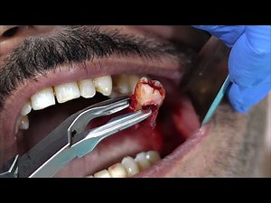 Extraction of Infected Wisdom Tooth and Second Molar Root Stumps | Third Molar Tooth Extraction.