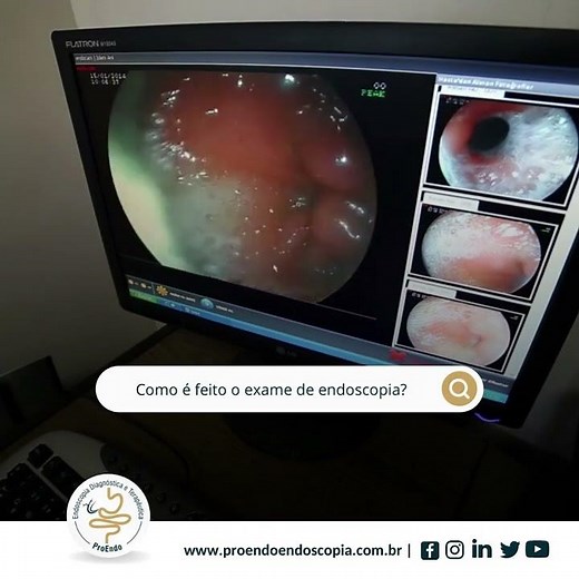 Como é feito o exame de endoscopia?