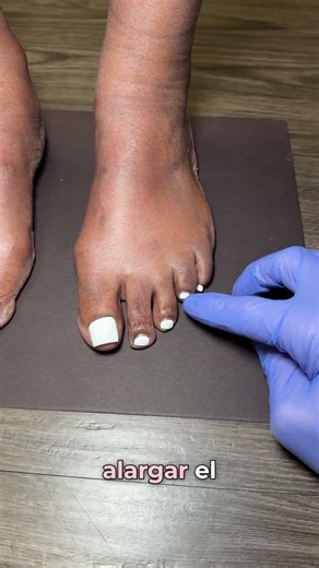 THE BRACHYBALANCING ™️ SURGERY EXPLAINED 👨🏻‍⚕️