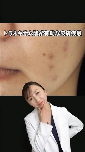 【皮膚科医が教える】トラネキサム酸が効く皮膚疾患