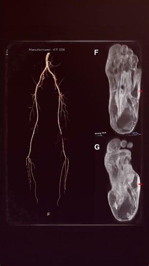 Diabetic Foot Warning Signs | Early Detection & Treatment Tips | Dr. Tahir Shah | Evercare Hospital