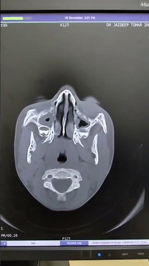 #anatomy of ncct brain soft window with bone window