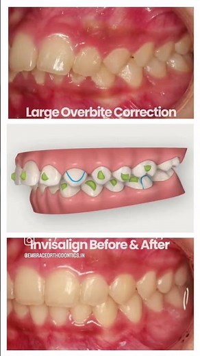 Overbite correction with Invisalign | Before - After #invisalignbeforeandafter #invisaligntreatment