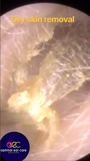Dry skin + stubborn ear wax? 👂✨ #satisfying #earwaxremoval