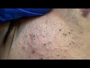 Deep Cleanse & Acne Treatment | Facial Care Routine