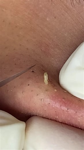 Relaxing Pimple Pops for Clear Skin