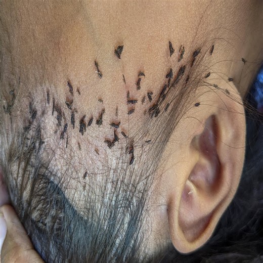 Remove all hundred lice from hair - Getting out all thousand lice from head | Jeramiah Mckenzie