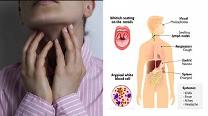 15 Red Flags That Reveal Mononucleosis