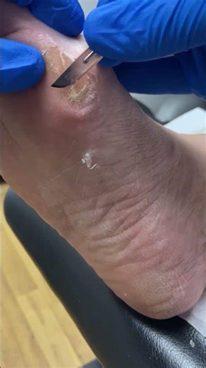 Fix Bunions Fast: Stop Overpronation & Prevent Calluses Today! #FootCare #HealthyFeet