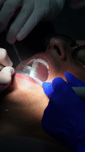 Tooth Filling Procedure Step by Step | Dentist Repairing Damaged Tooth