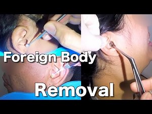 Removal of Foreign Body Stuck from People's Ears Compilation