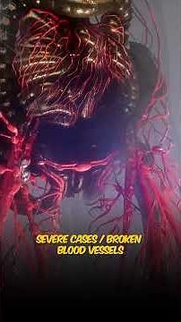 Pseudocyst in the Pancreas — Is It Dangerous? Here’s What You Need to Know!