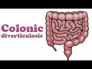 Colonic diverticulosis - a look at CT abdomen and pelvis without intravenous iodinated contrast