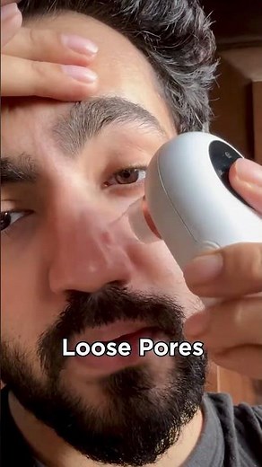 Blackheads Removal Tool| How to remove blackheads at home| Plastic Blackhead Remover Vacuum Suction