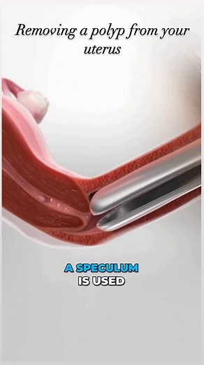 Holistic Health Treatment on Instagram: "Follow (us) @norelie.co for more pain relief and nerve health tips. Removing a polyp from your uterus, also known as endometrial polyp removal, is a minimally invasive procedure typically done with a hysteroscope. This involves inserting a thin, lighted tube through your vagina and cervix into your uterus. Gas or saline is used to expand the uterus for better visibility, and the polyp is then removed using specialized instruments like scissors, a laser, o