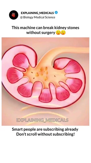 “Imagine breaking a rock inside the body with waves… 🌊”#kidneystone #lithotripsy #shockwave #kidneys