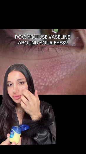 Beware of Vaseline! How it Leads to Milia Under Eyes