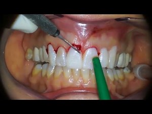 Gingivectomy - Procedure to eliminate suprabony pockets || Dental Clinic