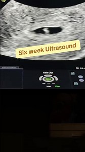 Seeing Baby So Early! 6-Week Ultrasound POV 😍