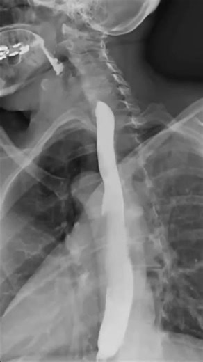 Dynamic X-Ray Retrospective View of theEsophagus in Motion | Konica MinoltaHealthcare