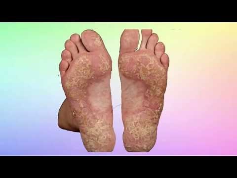 psoriasis palmo-plantaire