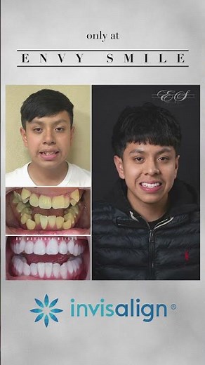 Watch this amazing Invisalign transformation! brought to you by Envy Smile Dental Spa in Brooklyn.
